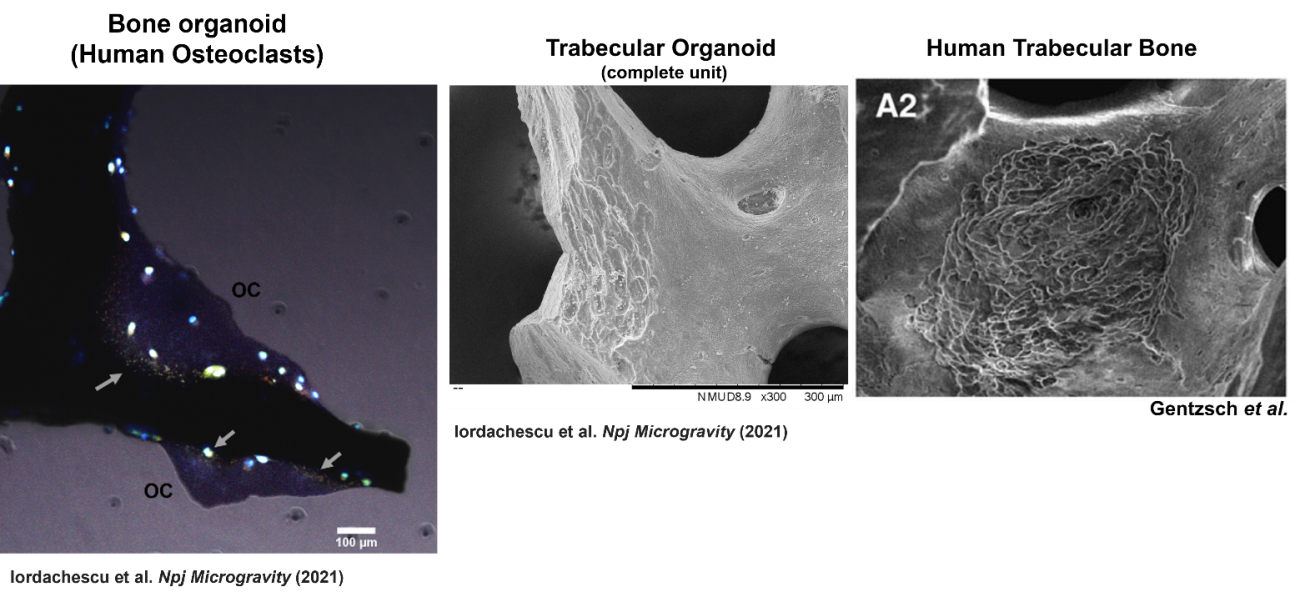 Left: A trabecular bone organoid containing osteoclasts. Right: Resorption lacunae created by osteoclasts on the organoid surface, Right: Typical resorption lacunae in human trabecular bone.
