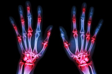 X-ray of left and right hand showing joint inflammation from Rheumatoid arthritis